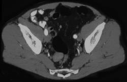 Splenosis in Pelvis and Left Upper Quadrant - CTisus CT Scan