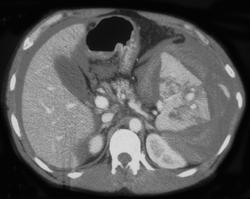 Splenic Laceration and Hemoperitoneum - CTisus CT Scan