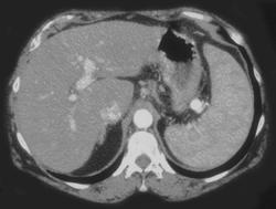 Splenic Artery Aneurysm - CTisus CT Scan