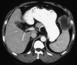 Splenic Lymphoma - CTisus CT Scan