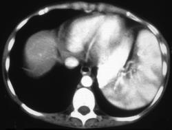 Moire (normal) Spleen - CTisus CT Scan