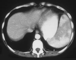 Normal Splenic Enhancement - CTisus CT Scan