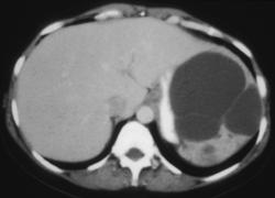 Multiple Splenic Cysts - CTisus CT Scan