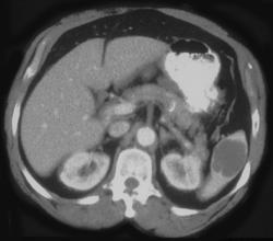 Epithelial Cyst - CTisus CT Scan