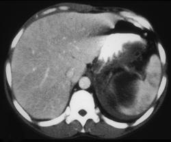 Pancreatitis Involves Spleen - CTisus CT Scan