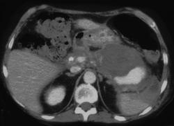 Splenic Artery Pseudoaneurysm in A Patient With Pancreatitis - CTisus CT Scan