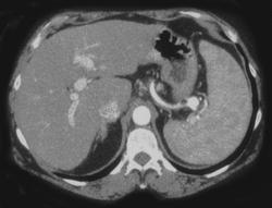 Splenic Artery Aneurysm - CTisus CT Scan