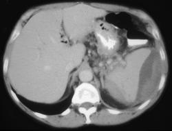 Subcapsular Splenic Hematoma - CTisus CT Scan