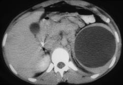 Splenic Cyst - CTisus CT Scan