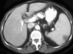 Splenic Infarction - CTisus CT Scan