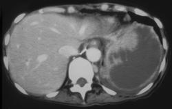 Global Splenic Infarction - CTisus CT Scan