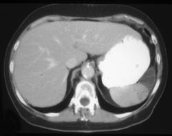 Splenic Infarction - CTisus CT Scan