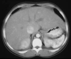 Sickle Cell Disease (ss) - CTisus CT Scan