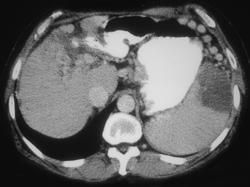 Cirrhosis With Portal Hypertension and Splenic Infarction - CTisus CT Scan