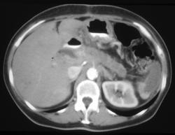 Splenic Infarction Due to Pancreatic Cancer - CTisus CT Scan