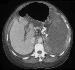 Splenic Infarction - CTisus CT Scan