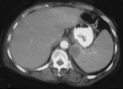 Splenic Abscess - CTisus CT Scan