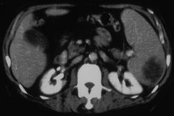 Splenic Abscess - CTisus CT Scan