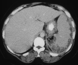 Splenic Abscess With Air in Abscess - CTisus CT Scan