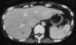 Tuberculosis (TB) of the Liver and Spleen - CTisus CT Scan