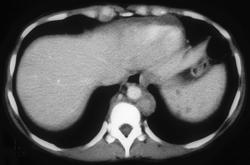 Mai Liver and Spleen With Nodes - CTisus CT Scan