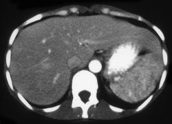 Candidiasis Spleen in Leukemia Patient - CTisus CT Scan