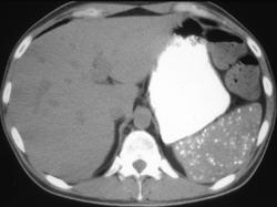 Pneumocystis Spleen - CTisus CT Scan