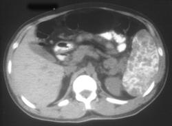 Pneumocystis Spleen (2 Cases) - CTisus CT Scan