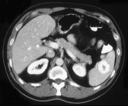 Splenic Hemangioma - CTisus CT Scan