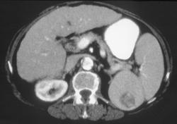 Splenic Hemangioma - CTisus CT Scan