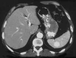 Splenic Hemangioma - CTisus CT Scan