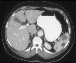 Splenic Hemangioma - CTisus CT Scan