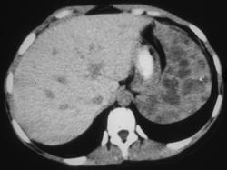 Splenic Hemangioma in Patient With Klippel Trenaunay Weber (KTW) Syndrome - CTisus CT Scan