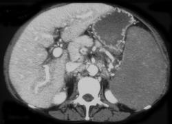 Lymphoma - CTisus CT Scan