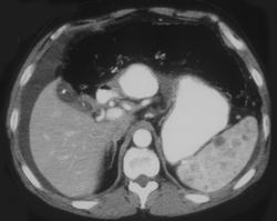 Lymphoma - CTisus CT Scan