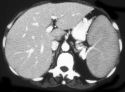 Lymphoma - CTisus CT Scan