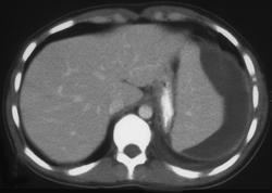 Subcapsular Hematoma in Patient With Mononucleosis - CTisus CT Scan