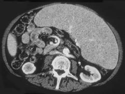 Lymphoma - CTisus CT Scan