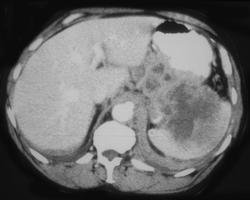 Lymphoma Involves Stomach, Pancreas, and Spleen - CTisus CT Scan