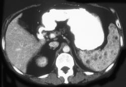 Lymphoma - CTisus CT Scan