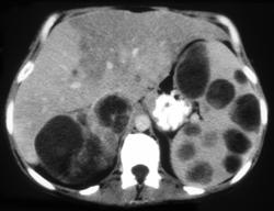 Metastatic Melanoma to the Spleen and Right Adrenal Gland - CTisus CT Scan