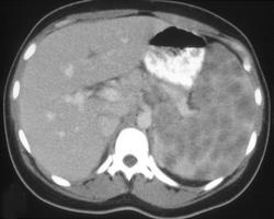 Sarcoidosis - CTisus CT Scan