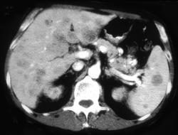 Lymphoma - CTisus CT Scan