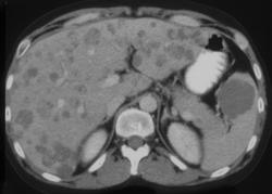 Lymphoma - CTisus CT Scan