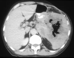 Splenic Necrosis and Lymphoma - CTisus CT Scan