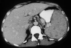 Lymphoma - CTisus CT Scan