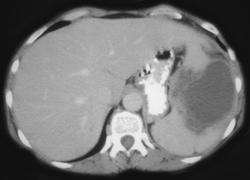 Lymphoma - CTisus CT Scan