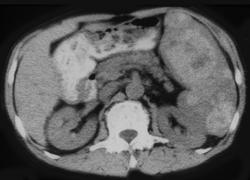 Angiosarcoma of the Spleen - CTisus CT Scan