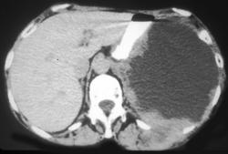 Metastatic Melanoma - CTisus CT Scan