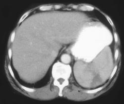 Splenic Infarctions - CTisus CT Scan